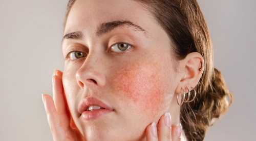 Tratamiento Rosacea
