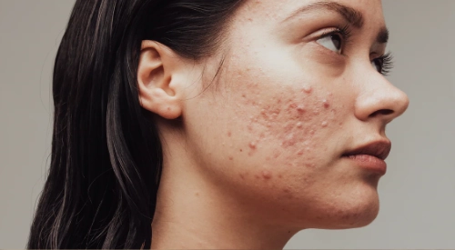 tratamiento acne