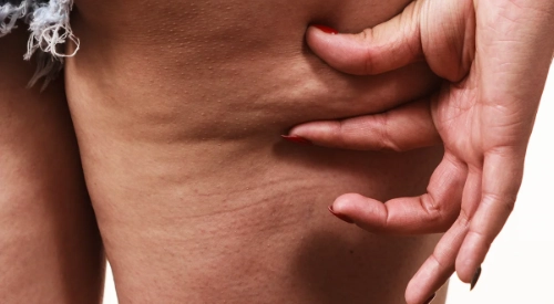 tratamiento celulitis