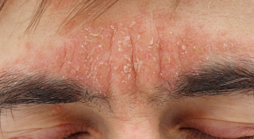 tratamiento dermatitis